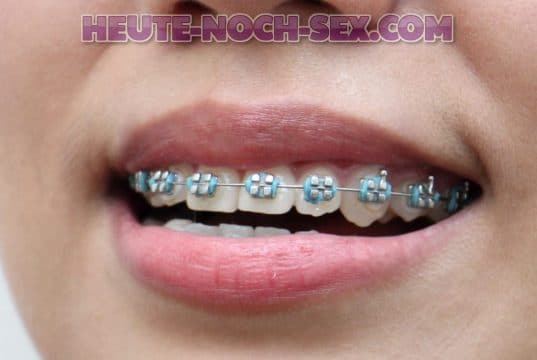 Hast du Bock auf eine frau mit Zahnspange?